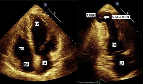 what is ventricular aneurysm.